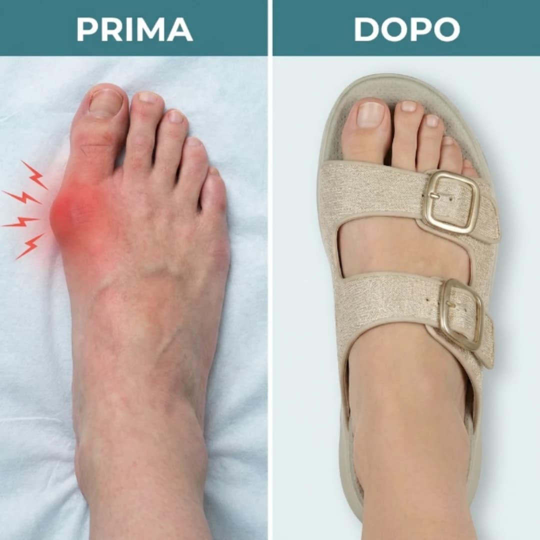 Dita libere e alluce allineato, sollievo per alluce valgo